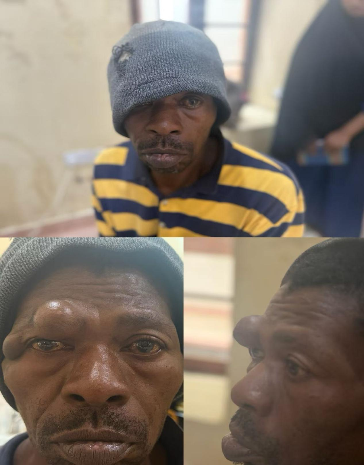 患者術(shù)前，兩枚腫塊壓迫眼瞼.中國(guó)援桑醫(yī)療隊(duì)供圖