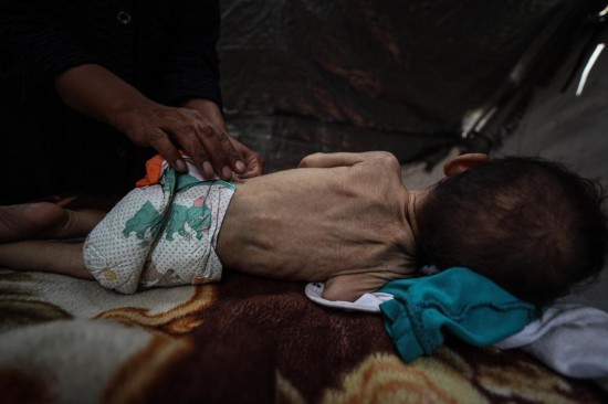 這是5月28日在加沙城西部一處臨時(shí)安置點(diǎn)拍攝的一名營(yíng)養(yǎng)不良的嬰兒。新華社發(fā)（馬哈茂德·扎基攝）