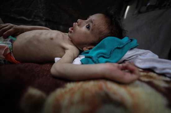 這是5月28日在加沙城西部一處臨時(shí)安置點(diǎn)拍攝的一名營養(yǎng)不良的嬰兒。新華社發(fā)（馬哈茂德·扎基攝）
