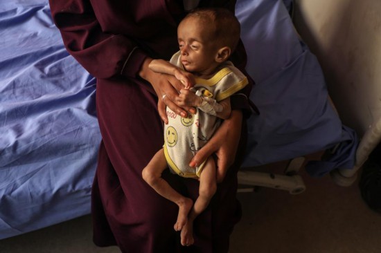 這是7月23日在加沙城一所醫(yī)院里拍攝的營養(yǎng)不良的兒童。新華社發(fā)（里澤克·阿卜杜勒賈瓦德攝）